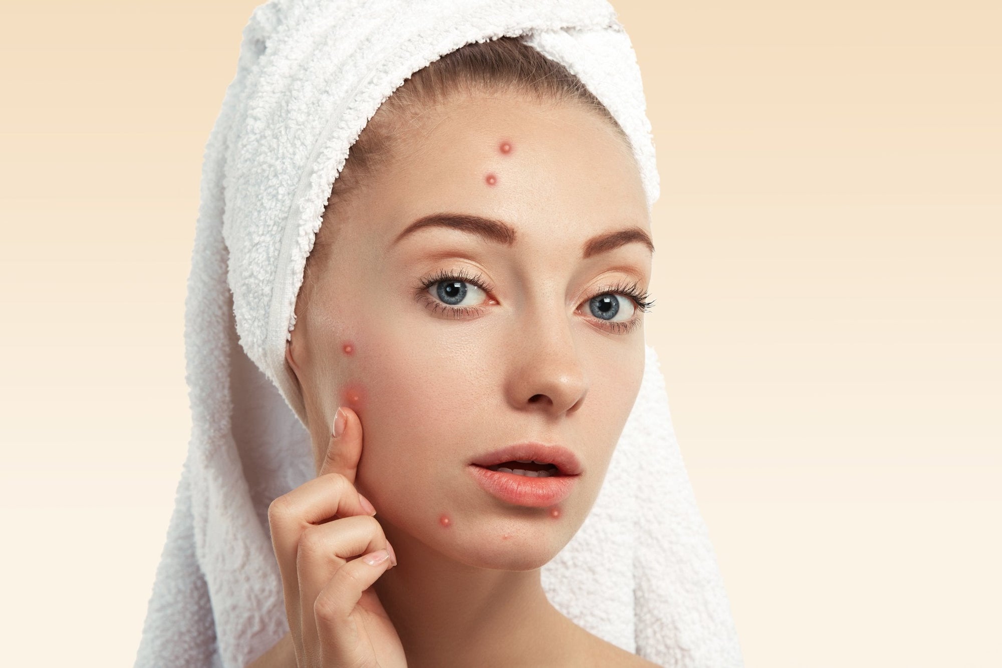 Pickel verstehen – Ursachen, Arten & sanfte Pflegetipps von Tilana Skincare